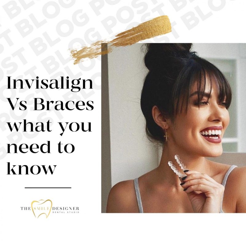 Invisalign Vs Braces, What You Need To Know