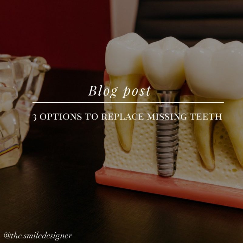 Options to replace missing tooth