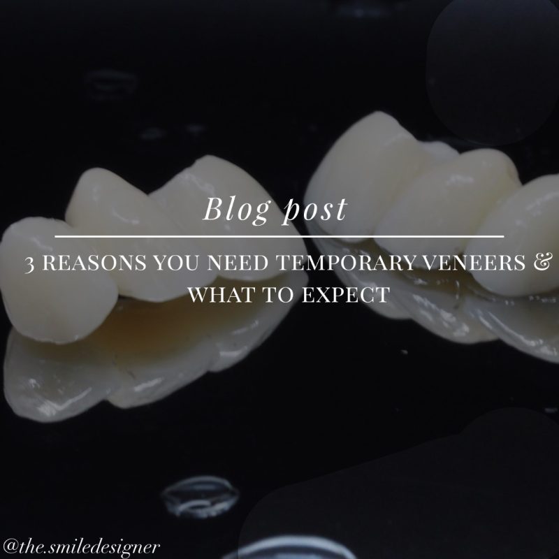 3 Reasons you need temporary veneers