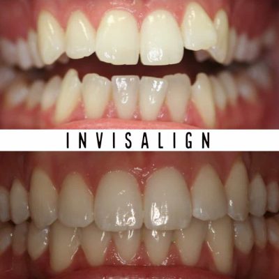 Invisalign