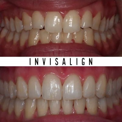 Invisalign