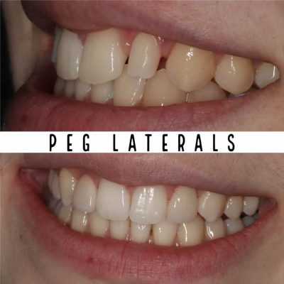 Peg Laterals