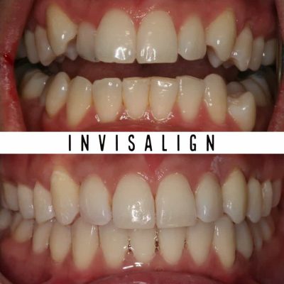 Invisalign