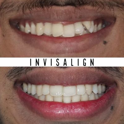 Invisalign