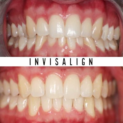 Invisalign