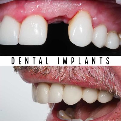 Dental Implants