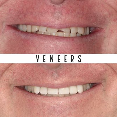 Veneers