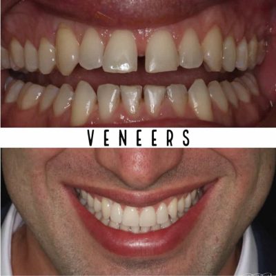 Veneers