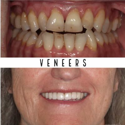 Veneers