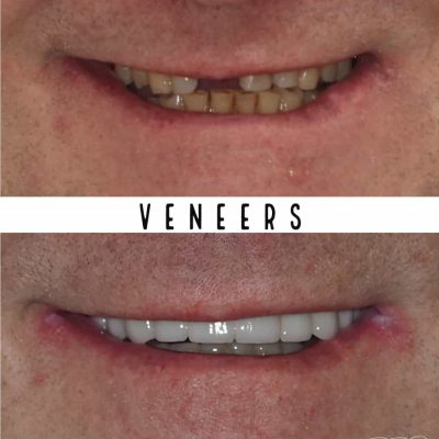 Veneers