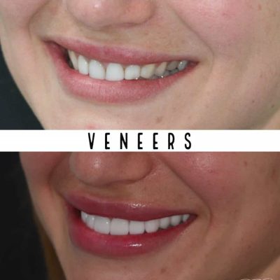 Veneers