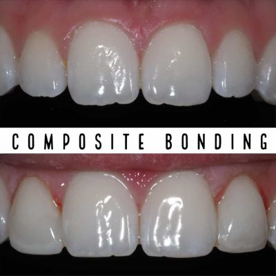 Composite Bonding