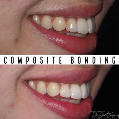 Composite Bonding