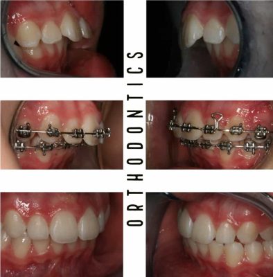 affordable braces melbourne before - after