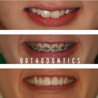 braces orthodontist melbourne before - after