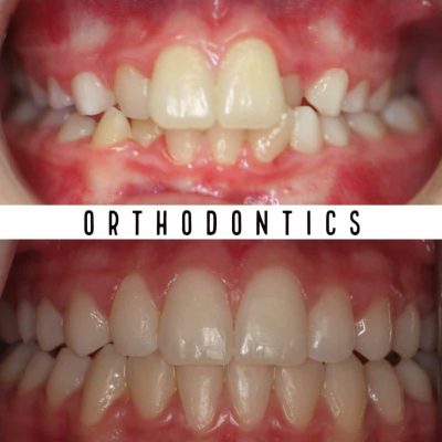 braces orthodontist melbourne before - after