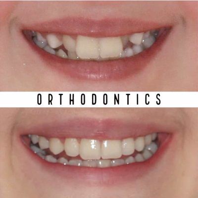 Orthodontists & Orthodontics Melbourne before - after