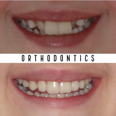 Orthodontist Melbourne before - after
