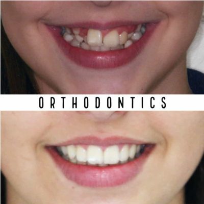 average cost of braces melbourne before - after