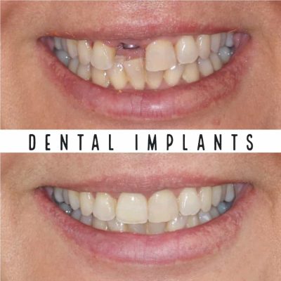 Dental Implants