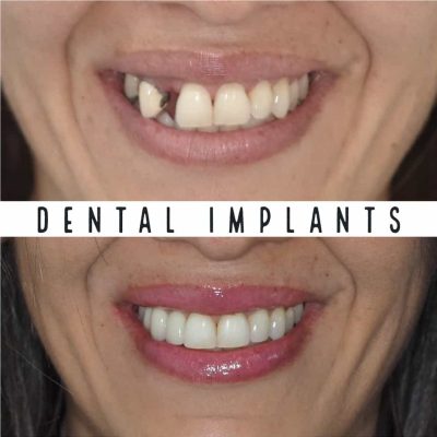 Dental Implants