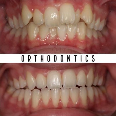 Melbourne Orthodontic before - after