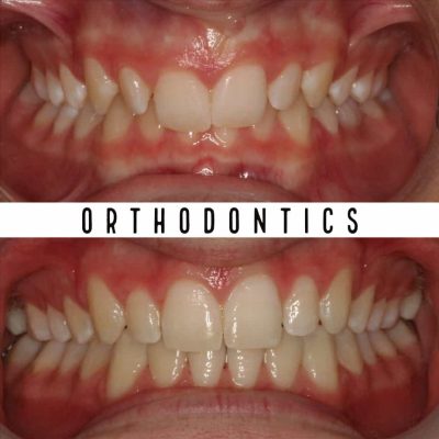 Orthodontist Melbourne before - after