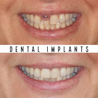 Dental Implants