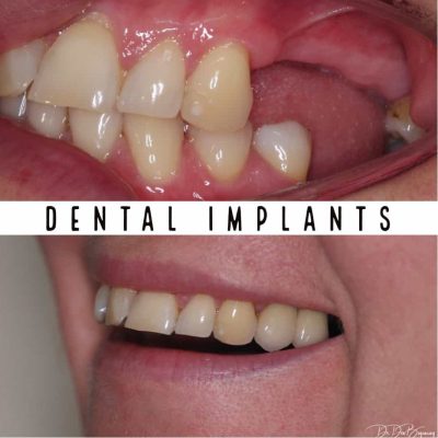 Dental Implants