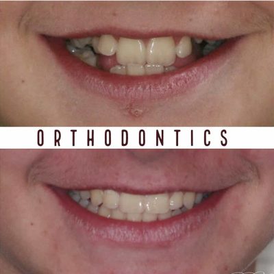 Affordable Orthodontist Melbourne before - after