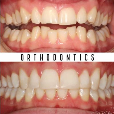 Best Orthodontists Melbourne before - after