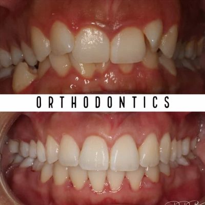 Best Orthodontists Melbourne before - after