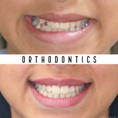 Best Orthodontists in Melbourne before - after