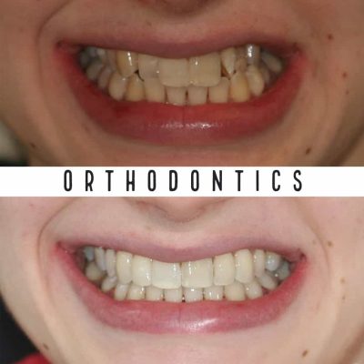 Affordable Orthodontist Melbourne before - after