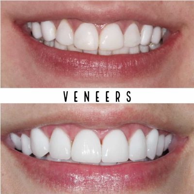 Veneers