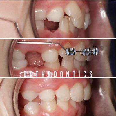 Kids Orthodontic Treatment