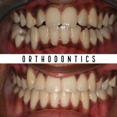 Orthodontic melbourne before - after