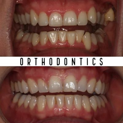 Orthodontics before - after