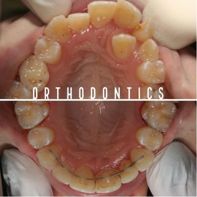 Orthodontic Specialists melbourne before - after