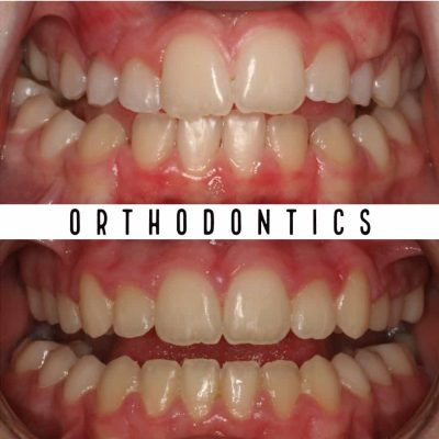 Before And Afters | Orthodontic Results Melbourne