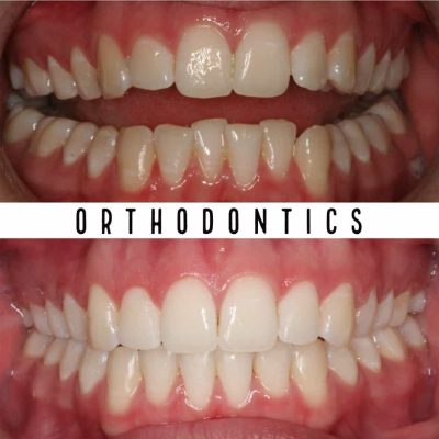 Before And Afters | Orthodontic Results Melbourne