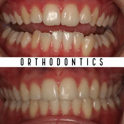 Before & After Orthodontic Treatment Results