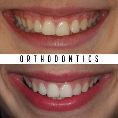 Before & After Orthodontic Treatment Results