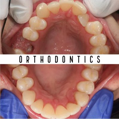 Before & After Orthodontic Treatment Results