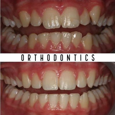 Before & After Orthodontic Treatment Results