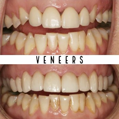 Veneers