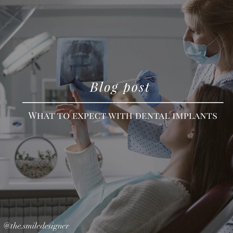 What to expect from Dental Implants