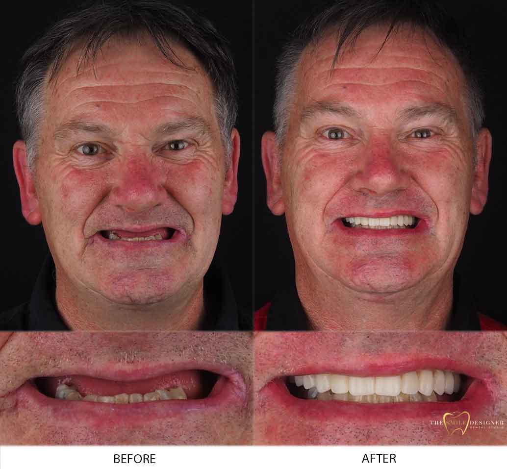 Devid Photo of Before and After Dental Implants Treatment