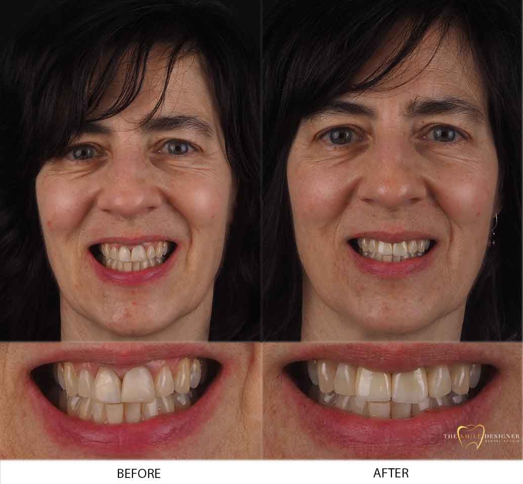 Gabriella's Photo of Before and After Dental Treatment