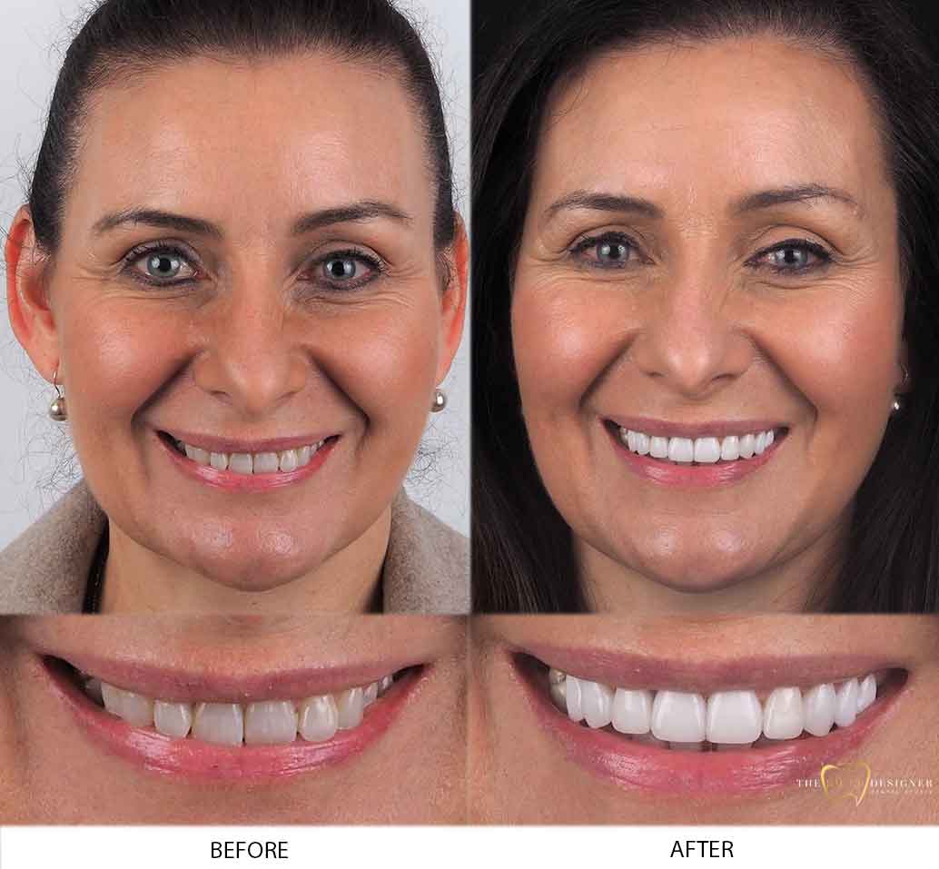 Ida's Photo of Before and After Dental Treatment